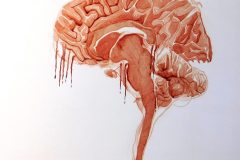GLIOSIS