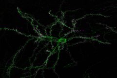Medium spiny neuron