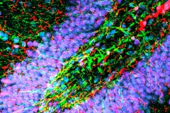 Inflamed hippocampus