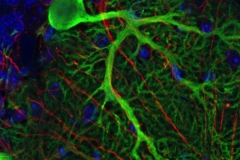 Massive Purkinje cell